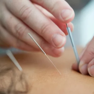 How To Find The Best Acupuncturist In Pennsylvania