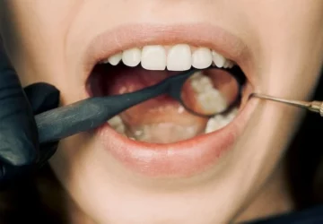 The Detailed Process Of Getting Snap-On Veneers