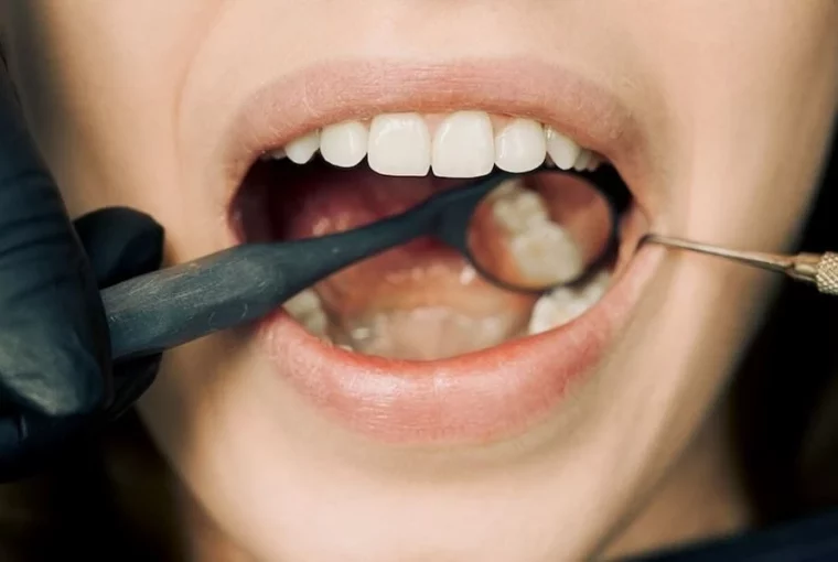 The Detailed Process Of Getting Snap-On Veneers