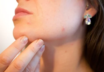 How To Tell If Your Acne Is Caused By Hormones 