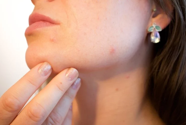 How To Tell If Your Acne Is Caused By Hormones 