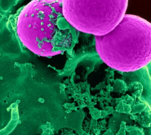 Understanding Recurrent Yeast Infections And Breakthrough Treatments